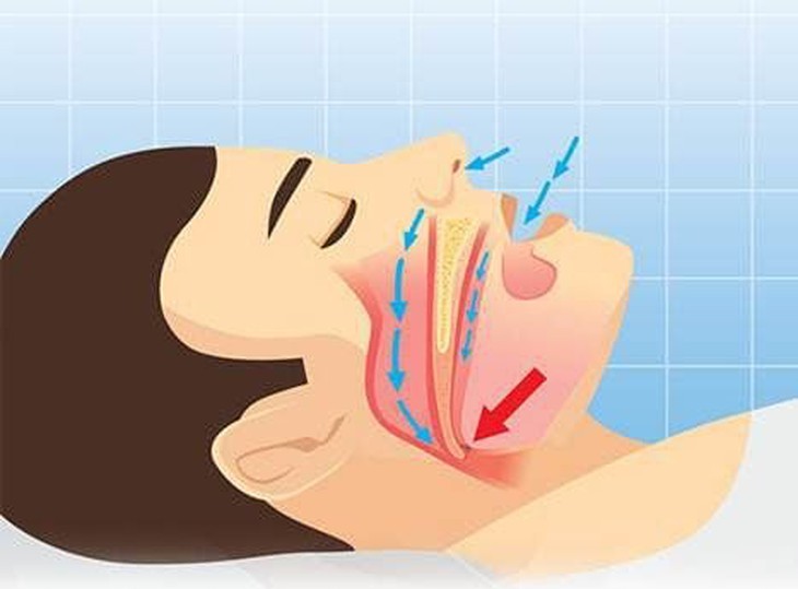 Khi nào cần phẫu thuật điều trị ngủ ngáy?- Ảnh 1.