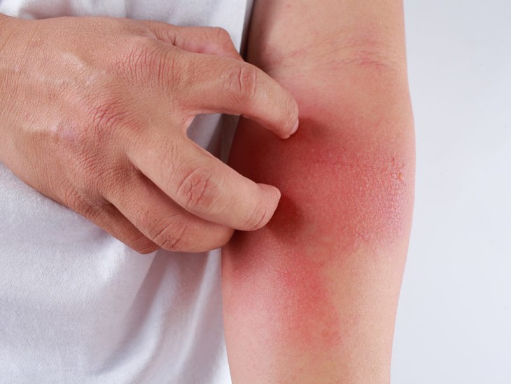 Các triệu chứng dị ứng thời tiết xuất hiện quanh năm, đặc biệt là thời điểm giao mùa.