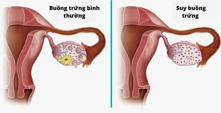 Bệnh vô kinh: Nguyên nhân, triệu chứng, phòng bệnh và cách điều trị- Ảnh 1.