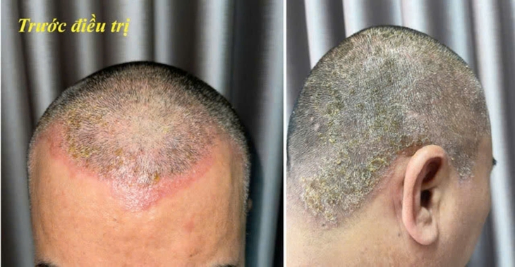 Dị ứng da đầu do thuốc nhuộm tóc- Ảnh 1.