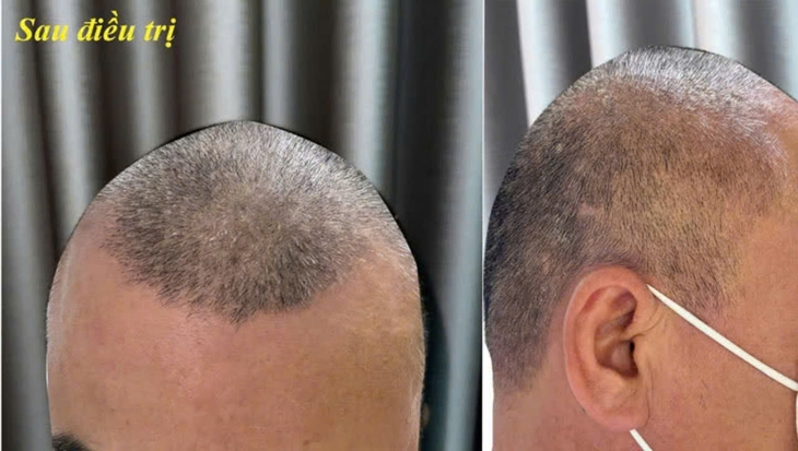 Dị ứng da đầu do thuốc nhuộm tóc- Ảnh 2.