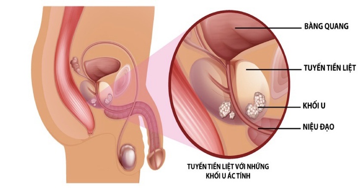 Khi nào nam giới nên tầm soát ung thư tuyến tiền liệt?- Ảnh 1. Khi nào nam giới nên tầm soát ung thư tuyến tiền liệt?- Ảnh 1.