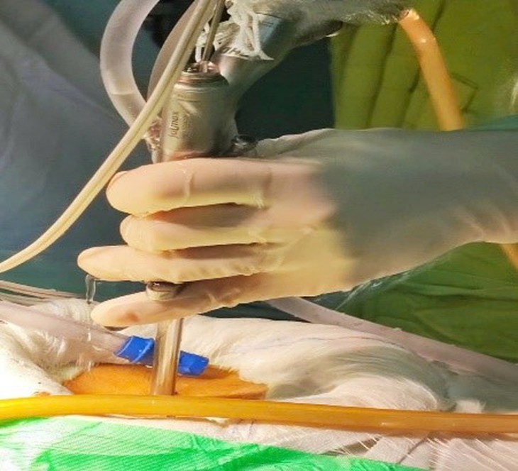 Bệnh viện Hữu nghị đa khoa Nghệ An tiên phong trong phẫu thuật nội soi điều trị thoát vị đĩa đệm- Ảnh 5. Bệnh viện Hữu nghị đa khoa Nghệ An tiên phong trong phẫu thuật nội soi điều trị thoát vị đĩa đệm- Ảnh 5.