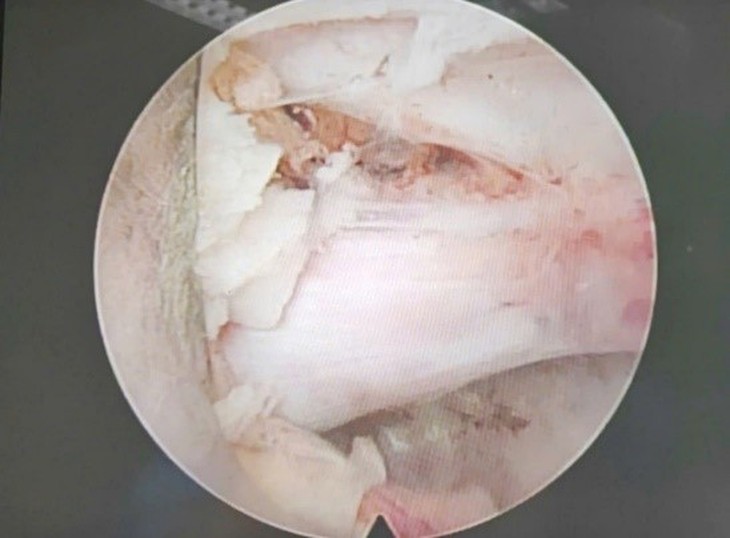 Bệnh viện Hữu nghị đa khoa Nghệ An tiên phong trong phẫu thuật nội soi điều trị thoát vị đĩa đệm- Ảnh 7. Bệnh viện Hữu nghị đa khoa Nghệ An tiên phong trong phẫu thuật nội soi điều trị thoát vị đĩa đệm- Ảnh 7.