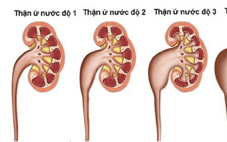Thận ứ nước: Nguyên nhân, triệu chứng và cách điều trị