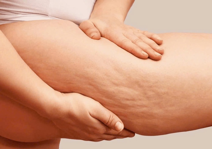 Đối phó với da sần vỏ cam- Ảnh 1. Đối phó với da sần vỏ cam- Ảnh 1.