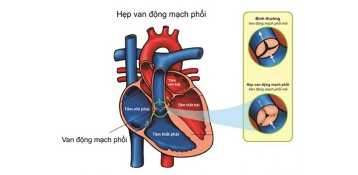 Thuốc nào điều trị hẹp van động mạch phổi?- Ảnh 1. Thuốc nào điều trị hẹp van động mạch phổi?- Ảnh 1.