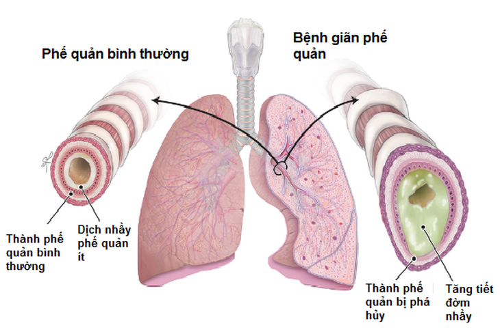 Chế độ dinh dưỡng tốt cho người bệnh giãn phế quản- Ảnh 1.