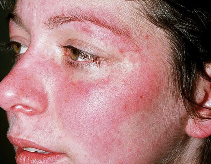 Lưu ý tập luyện cho người bệnh lupus ban đỏ- Ảnh 1.