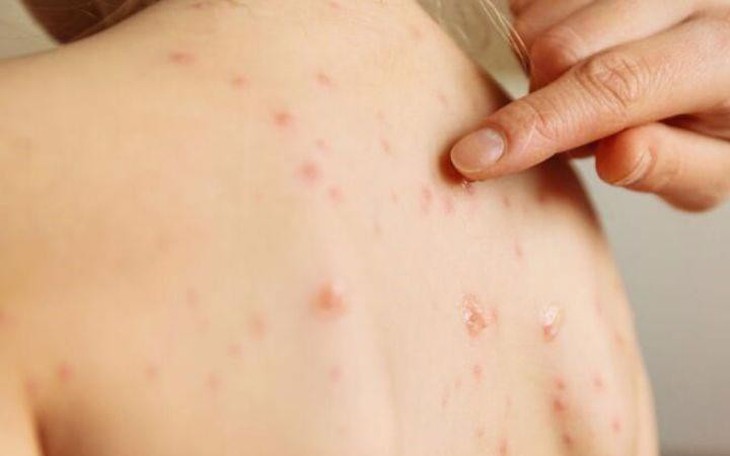 Bé trai ở Đồng Nai tử vong nghi do biến chứng của bệnh sởi