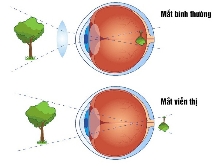 Câu hỏi thường gặp liên quan đến viễn thị- Ảnh 1.