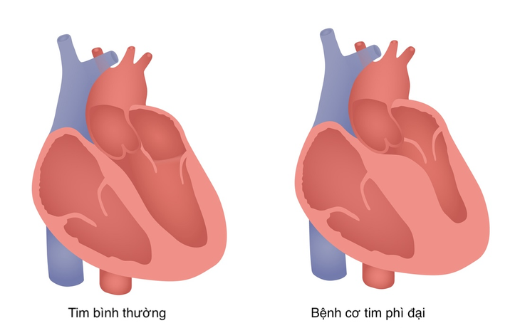 Bơm cồn sinh học cứu sống bệnh nhân bị bệnh cơ tim phì đại nặng- Ảnh 2. Bơm cồn sinh học cứu sống bệnh nhân bị bệnh cơ tim phì đại nặng- Ảnh 2.