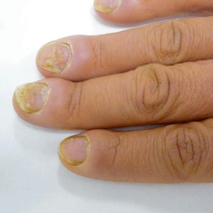 Nấm móng: Nguyên nhân, triệu chứng, lây truyền và cách điều trị- Ảnh 1.