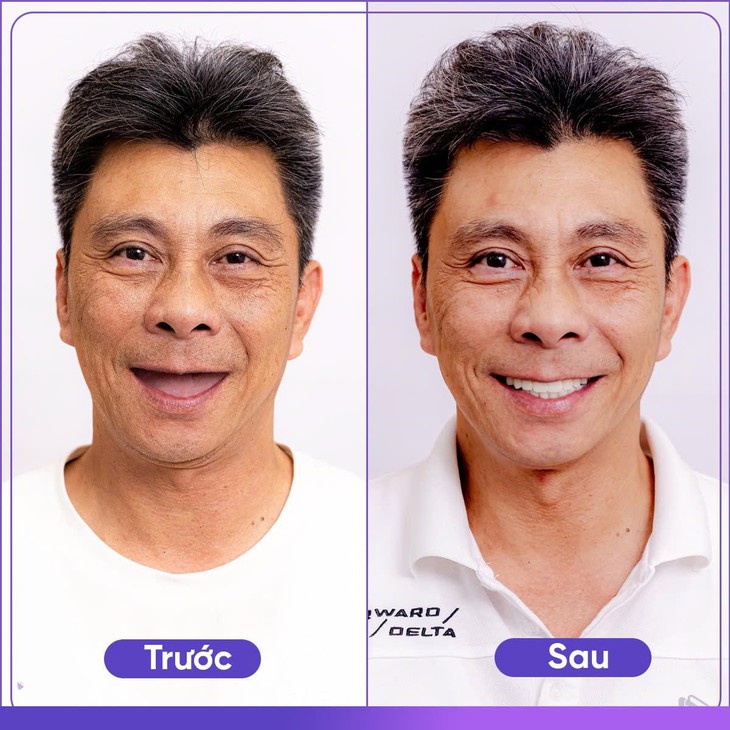 Nha khoa Alisa tiên phong ứng dụng công nghệ trồng răng Implant tức thì- Ảnh 2. Nha khoa Alisa tiên phong ứng dụng công nghệ trồng răng Implant tức thì- Ảnh 2.