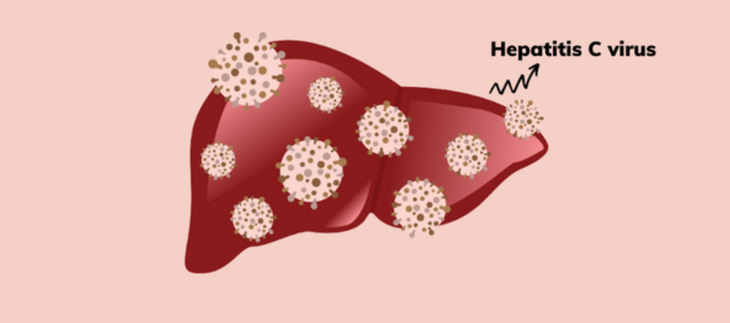 Kế hoạch điều trị viêm gan virus C ở người nhiễm HIV- Ảnh 1.