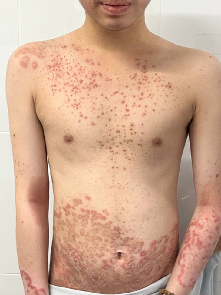 Mua thuốc trên mạng bôi chữa ngứa, thanh niên nhiễm nấm đầy người- Ảnh 3.