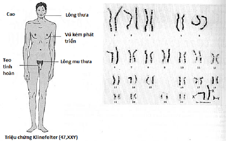 Hội chứng XYY có chữa được không?