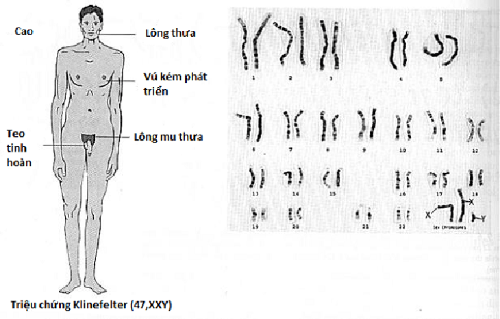 Hội chứng XYY có chữa được không?- Ảnh 1.