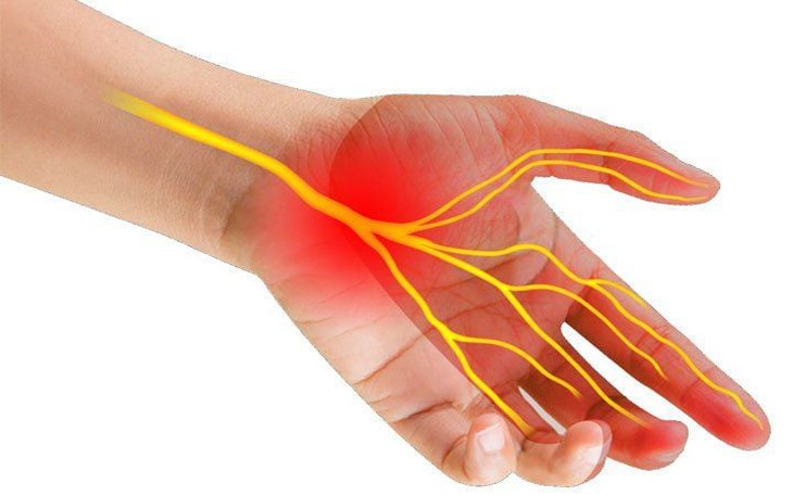 Tê tay cảnh giác với hội chứng ống cổ tay