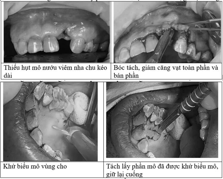 Ghép mô liên kết có cuống cải tiến mang lại nhiều đột phá trong điều trị khuyết hổng nướu- Ảnh 1. Ghép mô liên kết có cuống cải tiến mang lại nhiều đột phá trong điều trị khuyết hổng nướu- Ảnh 1.