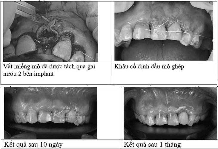 Ghép mô liên kết có cuống cải tiến mang lại nhiều đột phá trong điều trị khuyết hổng nướu- Ảnh 2. Ghép mô liên kết có cuống cải tiến mang lại nhiều đột phá trong điều trị khuyết hổng nướu- Ảnh 2.