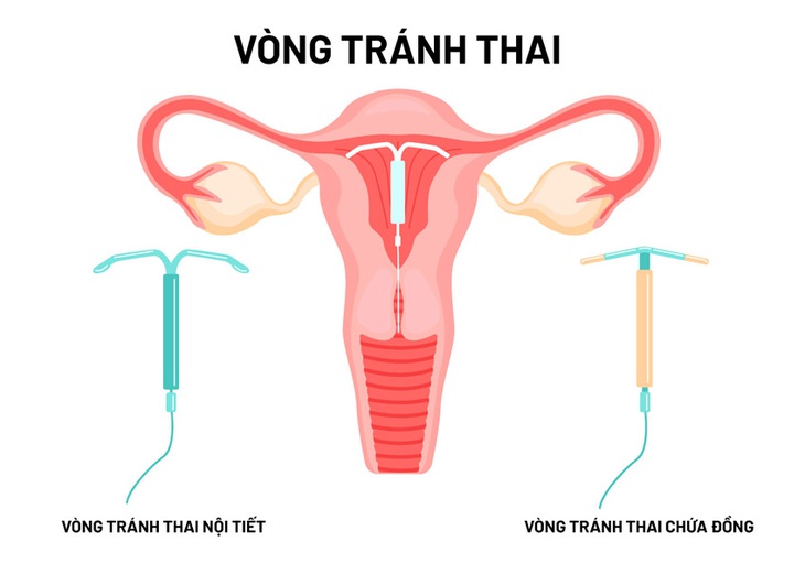 Muốn mang thai sau khi tháo vòng tránh thai cần lưu ý gì?- Ảnh 1.