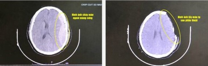 Hạ thân nhiệt cứu người đàn ông ngã thang chấn thương não- Ảnh 1.