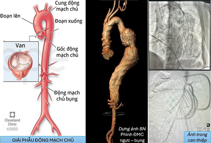 Cảnh giác với phình động mạch chủ ngực bụng- Ảnh 1.