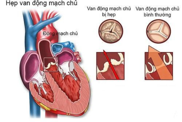 4 bài tập tốt cho người hẹp van động mạch chủ- Ảnh 1. 4 bài tập tốt cho người hẹp van động mạch chủ- Ảnh 1.