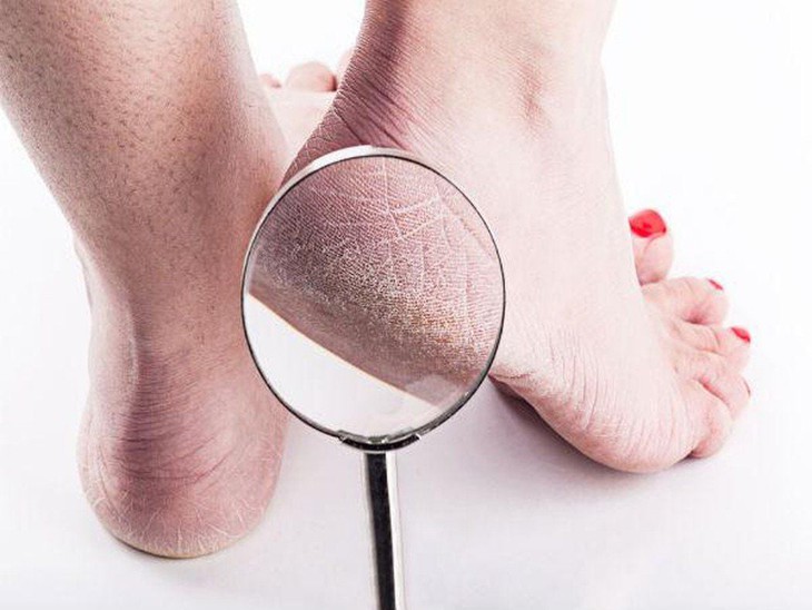 Chăm sóc nẻ gót chân mùa lạnh
- Ảnh 1.