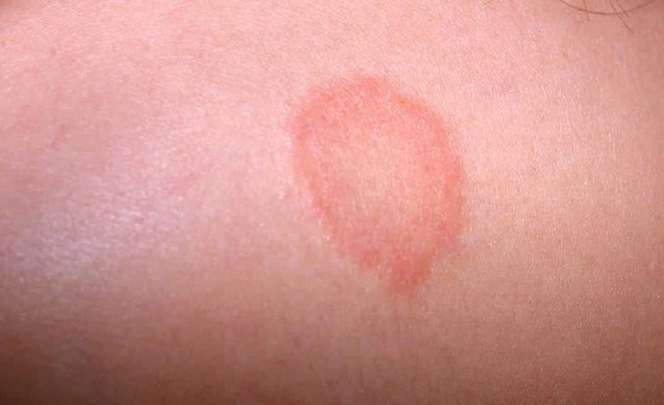 Bệnh lác đồng tiền là bệnh gì và cách điều trị, dự phòng - Ảnh 1.