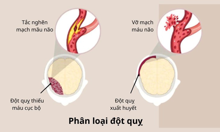 Cảnh báo nguy cơ đột quỵ não trong mùa lạnh ở người cao tuổi- Ảnh 2.