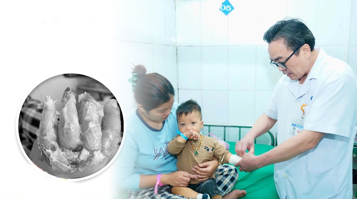 TS. BSCKII Thái Văn Bình chăm sóc, kiểm tra vết bỏng cho bệnh nhi H.Đ.K. TS. BSCKII Thái Văn Bình chăm sóc, kiểm tra vết bỏng cho bệnh nhi H.Đ.K.
