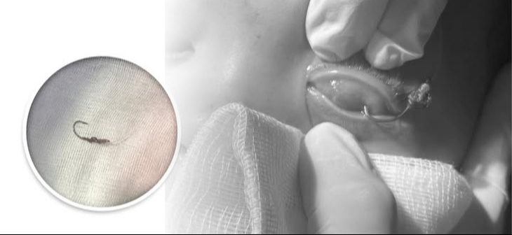 Bé trai bị lưỡi câu móc vào mắt- Ảnh 1. Bé trai bị lưỡi câu móc vào mắt- Ảnh 1.