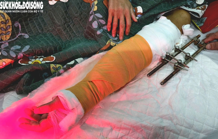 'Hồi sinh' cánh tay đứt rời cho nữ công nhân- Ảnh 3. 'Hồi sinh' cánh tay đứt rời cho nữ công nhân- Ảnh 3.