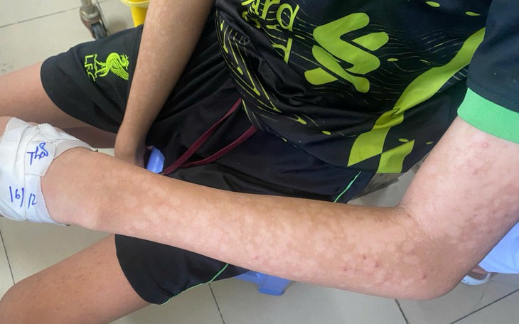 Bệnh nhân sởi tăng cao, tỉnh Bình Dương "thúc" tiêm nhanh vaccine