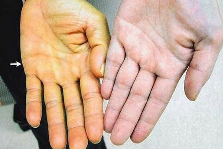 Chữa bệnh táo bón bằng lá lộc mại, người phụ nữ suy gan, suy thận- Ảnh 1. Chữa bệnh táo bón bằng lá lộc mại, người phụ nữ suy gan, suy thận- Ảnh 1.