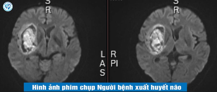 Cảnh báo chảy máu não do tự ý bỏ thuốc huyết áp- Ảnh 1.