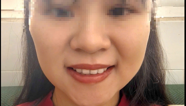 Khuôn mặt méo mó sau khi tiêm botox- Ảnh 1.