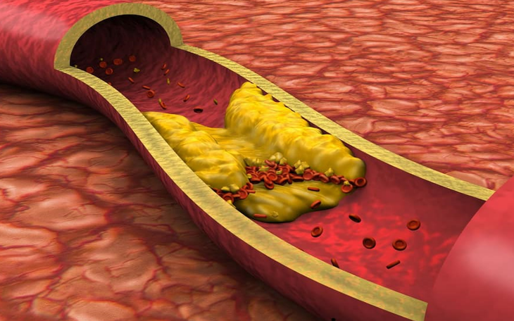 7 loại vitamin giúp ngăn ngừa xơ vữa động mạch