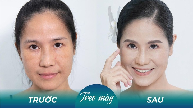 Diễn viên Kiều Trinh can thiệp thẩm mỹ trị sụp mí ở tuổi 50- Ảnh 3. Diễn viên Kiều Trinh can thiệp thẩm mỹ trị sụp mí ở tuổi 50- Ảnh 3.
