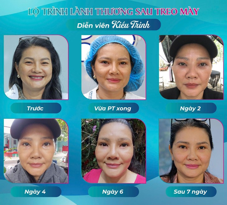 Diễn viên Kiều Trinh can thiệp thẩm mỹ trị sụp mí ở tuổi 50- Ảnh 4. Diễn viên Kiều Trinh can thiệp thẩm mỹ trị sụp mí ở tuổi 50- Ảnh 4.