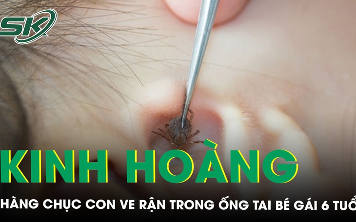 Nhờ tiệm cắt tóc lấy dị vật, bệnh nhân bị xung huyết ống tai- Ảnh 3.