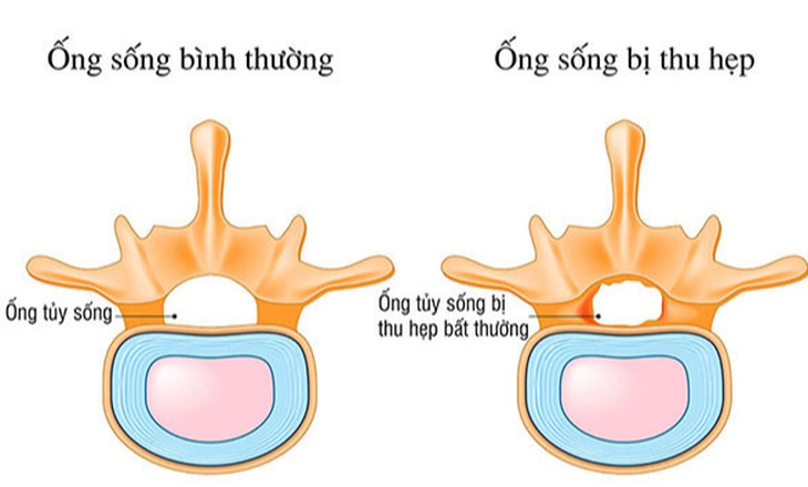 5 câu hỏi thường gặp với người bệnh hẹp ống sống- Ảnh 1.