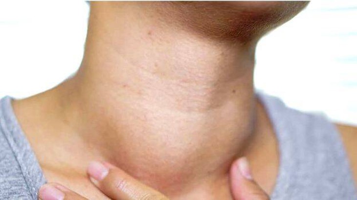 Thuốc điều trị lao hạch- Ảnh 1. Thuốc điều trị lao hạch- Ảnh 1.