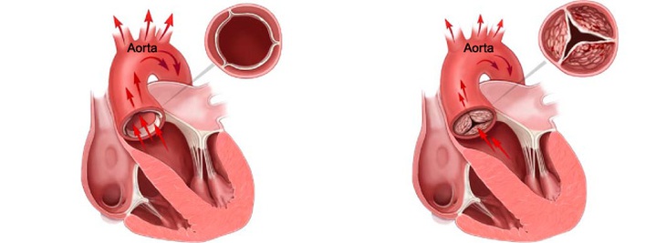 Các phương pháp và thuốc điều trị hẹp van động mạch chủ- Ảnh 2.