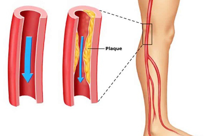 Đau chân khi đi bộ cảnh giác với bệnh động mạch chi dưới- Ảnh 1.