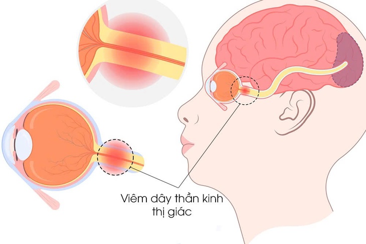 Viêm dây thần kinh thị giác: Nguyên nhân, triệu chứng, phòng bệnh và cách điều trị- Ảnh 1. Viêm dây thần kinh thị giác: Nguyên nhân, triệu chứng, phòng bệnh và cách điều trị- Ảnh 1.