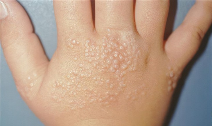 Bài tập cho người bệnh Lichen nitidus- Ảnh 1.