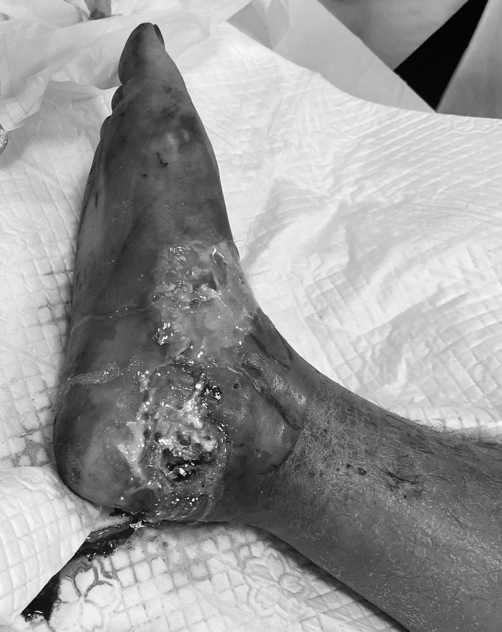 Thở máy ngay khi vào viện vì sai lầm tự chữa bệnh gout- Ảnh 2. Thở máy ngay khi vào viện vì sai lầm tự chữa bệnh gout- Ảnh 2.
